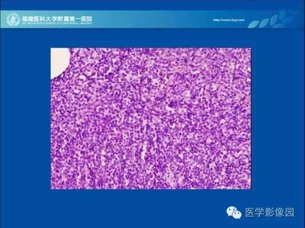 【病例】眼眶病变MR检查技术及诊断