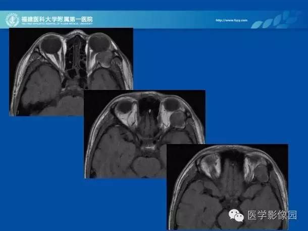 【病例】眼眶病变MR检查技术及诊断