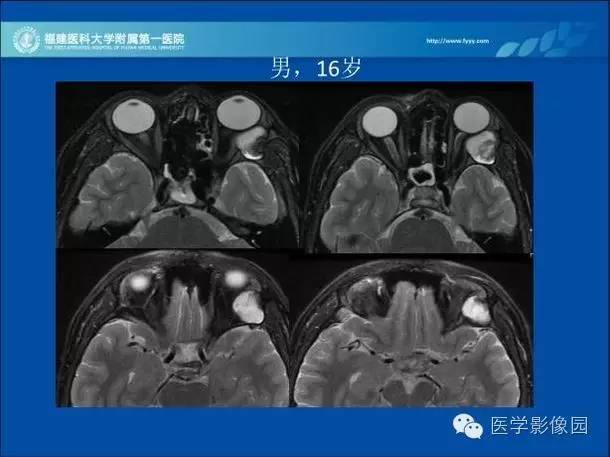 【病例】眼眶病变MR检查技术及诊断