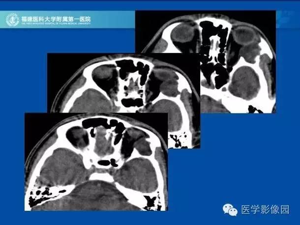 【病例】眼眶病变MR检查技术及诊断