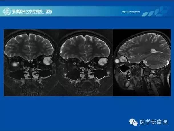 【病例】眼眶病变MR检查技术及诊断