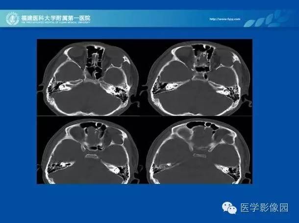 【病例】眼眶病变MR检查技术及诊断