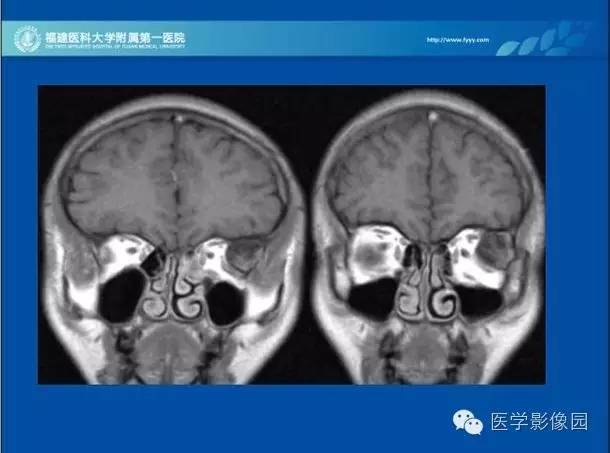【病例】眼眶病变MR检查技术及诊断