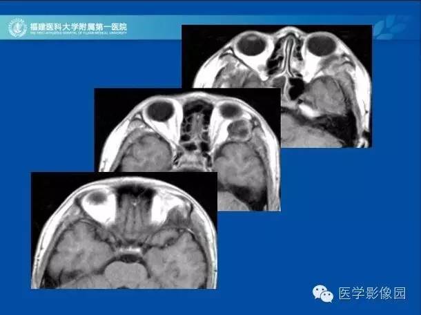 【病例】眼眶病变MR检查技术及诊断