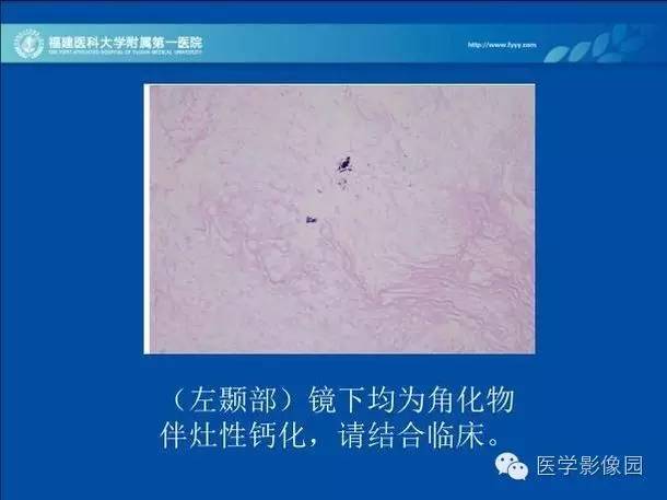 【病例】眼眶病变MR检查技术及诊断