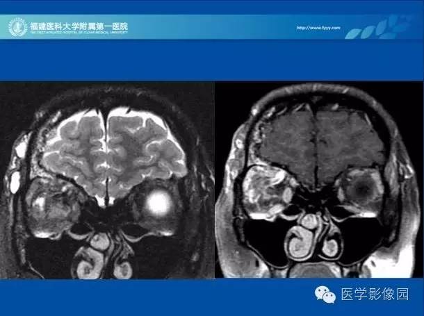 【病例】眼眶病变MR检查技术及诊断