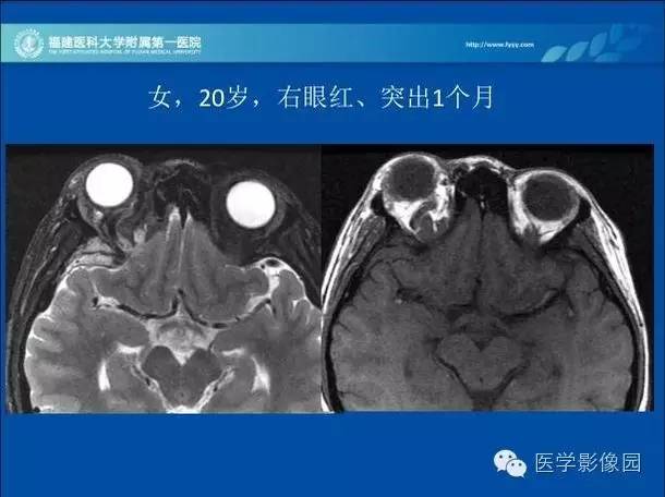 【病例】眼眶病变MR检查技术及诊断