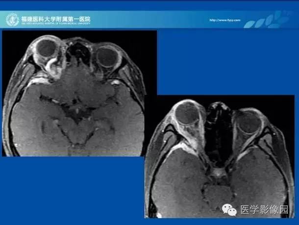 【病例】眼眶病变MR检查技术及诊断
