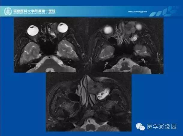 【病例】眼眶病变MR检查技术及诊断