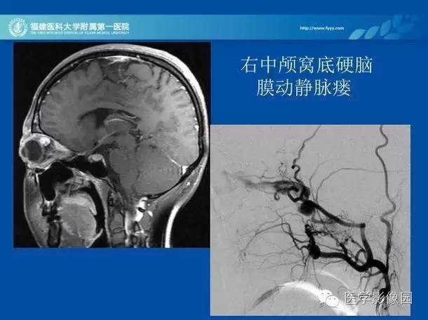 【病例】眼眶病变MR检查技术及诊断