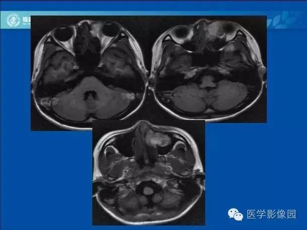 【病例】眼眶病变MR检查技术及诊断
