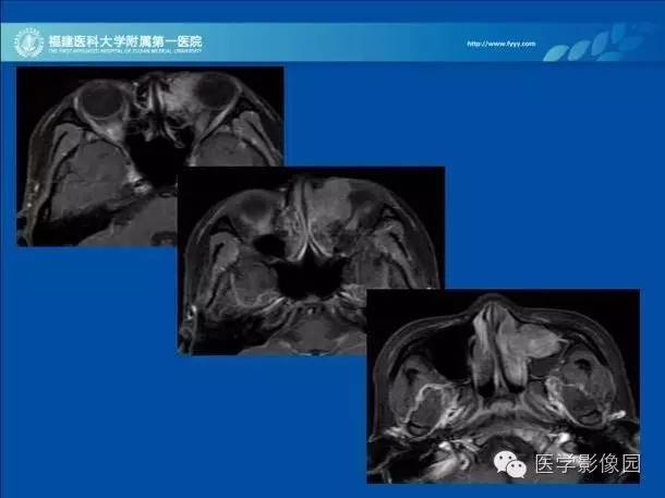 【病例】眼眶病变MR检查技术及诊断