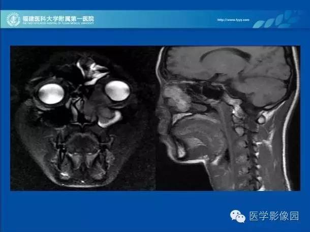 【病例】眼眶病变MR检查技术及诊断