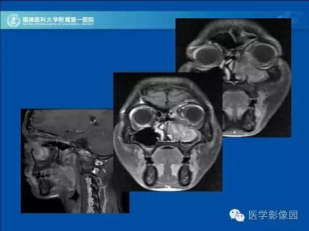 【病例】眼眶病变MR检查技术及诊断