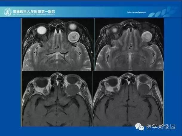 【病例】眼眶病变MR检查技术及诊断