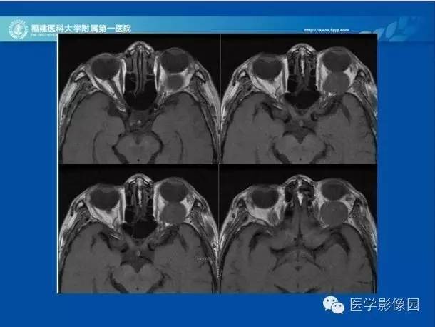 【病例】眼眶病变MR检查技术及诊断