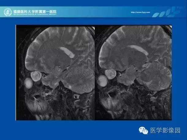 【病例】眼眶病变MR检查技术及诊断