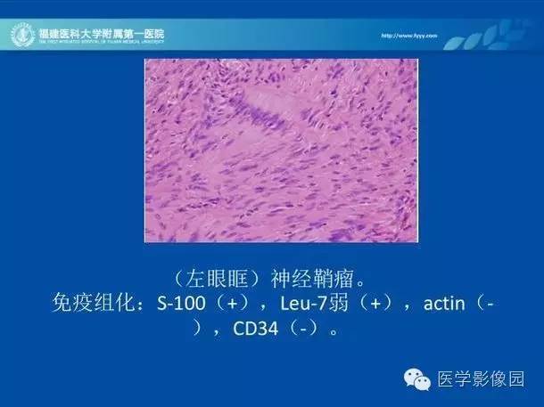 【病例】眼眶病变MR检查技术及诊断