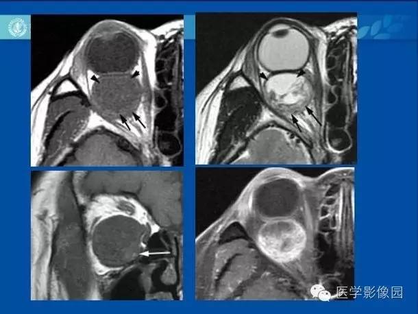 【病例】眼眶病变MR检查技术及诊断