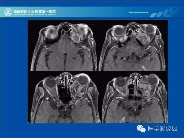 【病例】眼眶病变MR检查技术及诊断