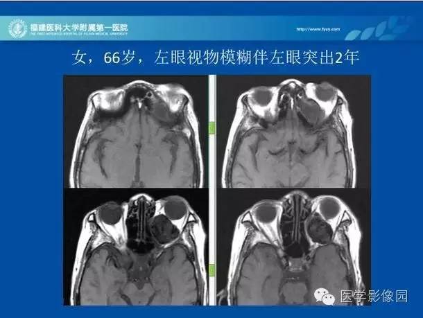【病例】眼眶病变MR检查技术及诊断