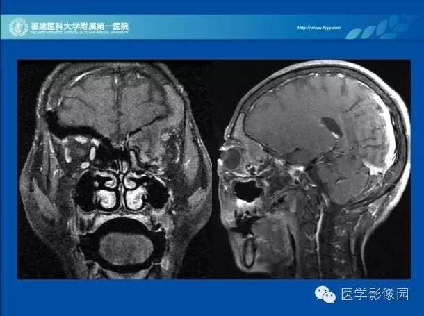 【病例】眼眶病变MR检查技术及诊断
