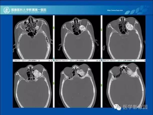 【病例】眼眶病变MR检查技术及诊断