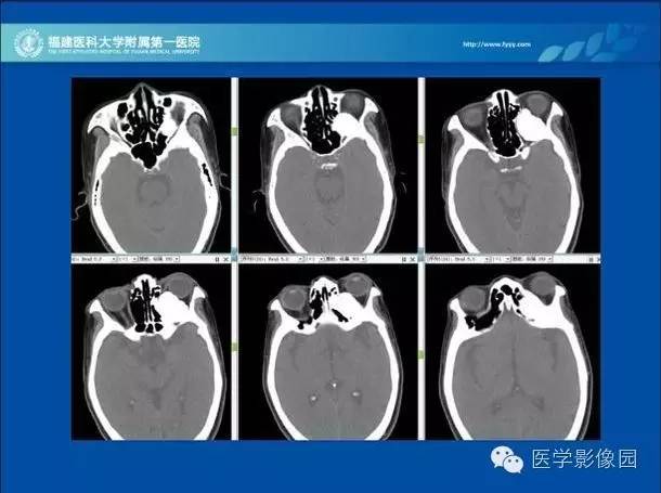 【病例】眼眶病变MR检查技术及诊断