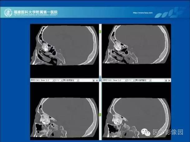 【病例】眼眶病变MR检查技术及诊断