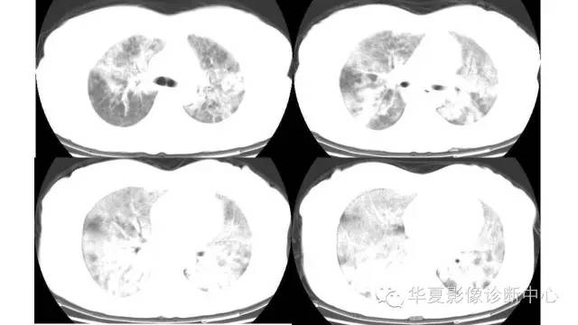 【病例】肺泡蛋白沉积症1例CT影像表现