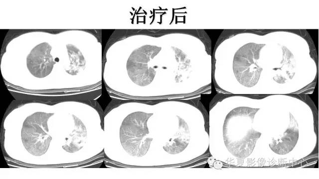 【病例】肺泡蛋白沉积症1例CT影像表现