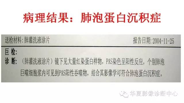 【病例】肺泡蛋白沉积症1例CT影像表现