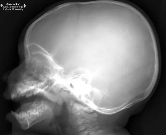 【病例】郎格罕细胞组织细胞增生症1例X线CT影像表现