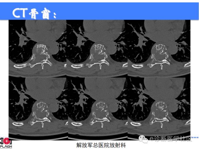 【病例】胸椎浆细胞瘤1例CT及MR影像表现