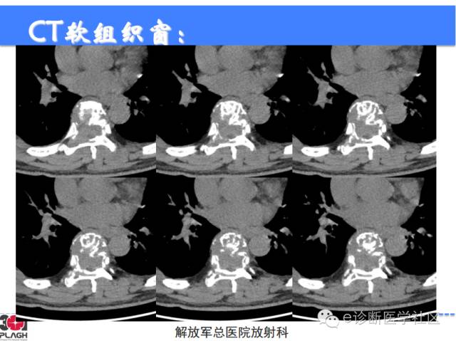 【病例】胸椎浆细胞瘤1例CT及MR影像表现