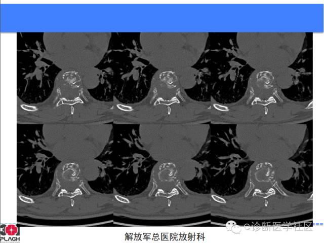 【病例】胸椎浆细胞瘤1例CT及MR影像表现
