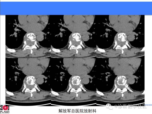 【病例】胸椎浆细胞瘤1例CT及MR影像表现