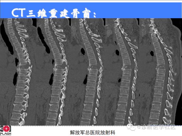 【病例】胸椎浆细胞瘤1例CT及MR影像表现