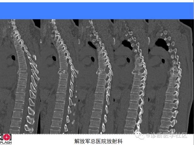 【病例】胸椎浆细胞瘤1例CT及MR影像表现