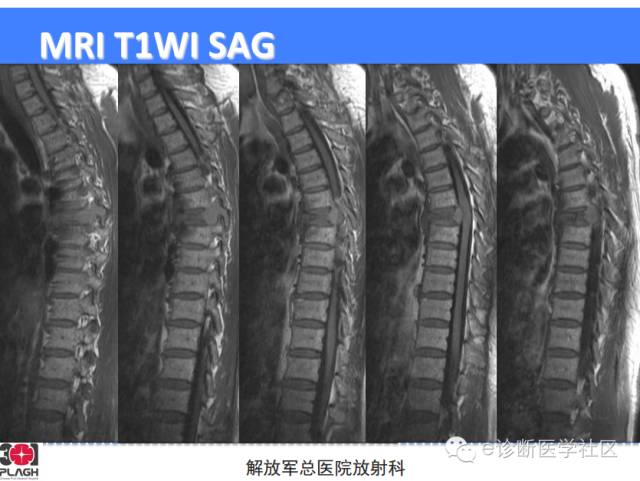 【病例】胸椎浆细胞瘤1例CT及MR影像表现