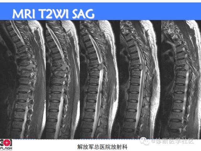 【病例】胸椎浆细胞瘤1例CT及MR影像表现