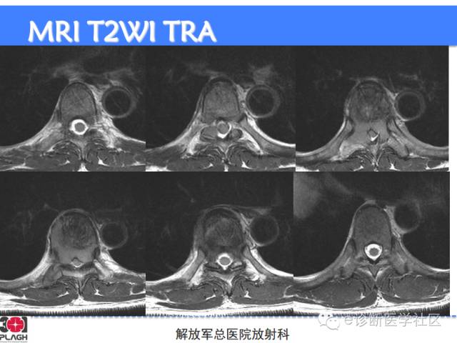 【病例】胸椎浆细胞瘤1例CT及MR影像表现