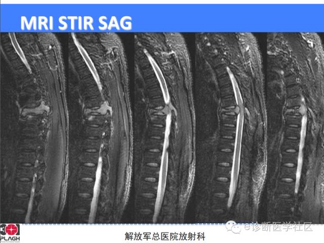 【病例】胸椎浆细胞瘤1例CT及MR影像表现