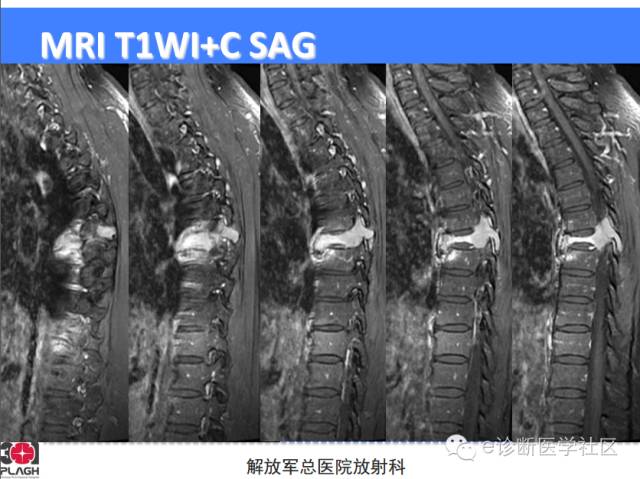 【病例】胸椎浆细胞瘤1例CT及MR影像表现