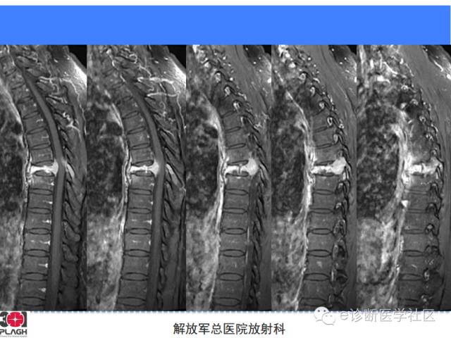 【病例】胸椎浆细胞瘤1例CT及MR影像表现