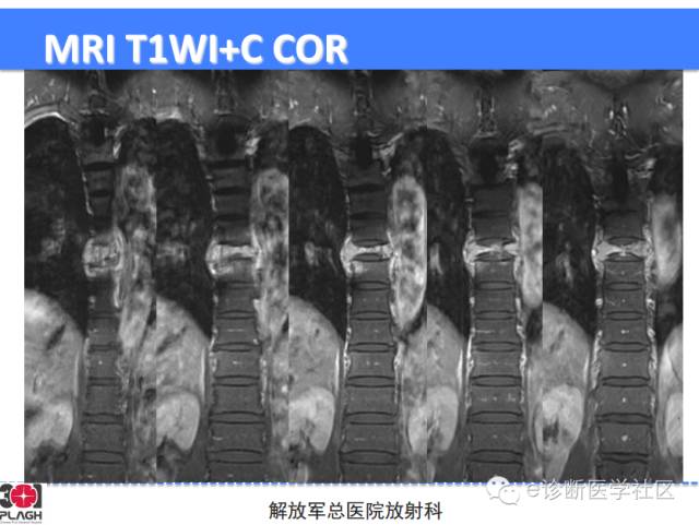 【病例】胸椎浆细胞瘤1例CT及MR影像表现