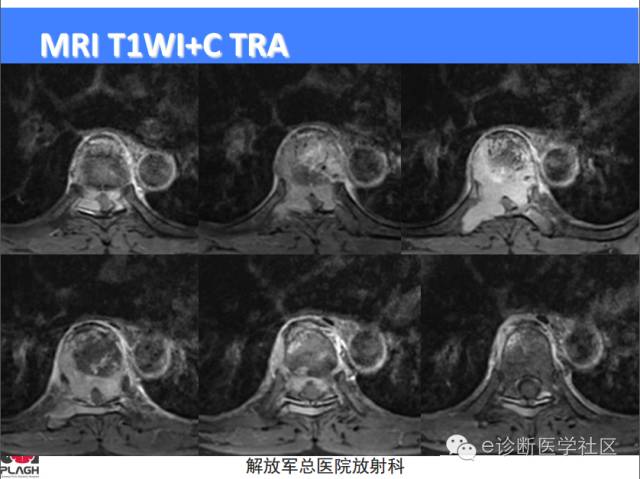 【病例】胸椎浆细胞瘤1例CT及MR影像表现