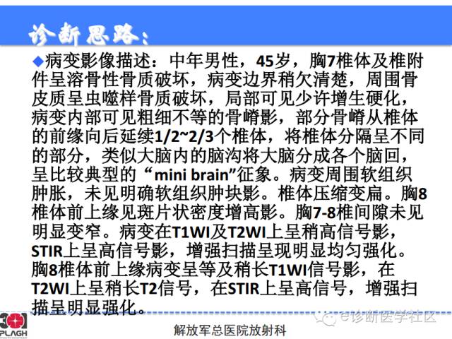 【病例】胸椎浆细胞瘤1例CT及MR影像表现