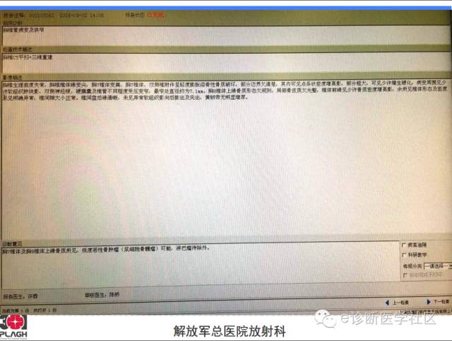 【病例】胸椎浆细胞瘤1例CT及MR影像表现
