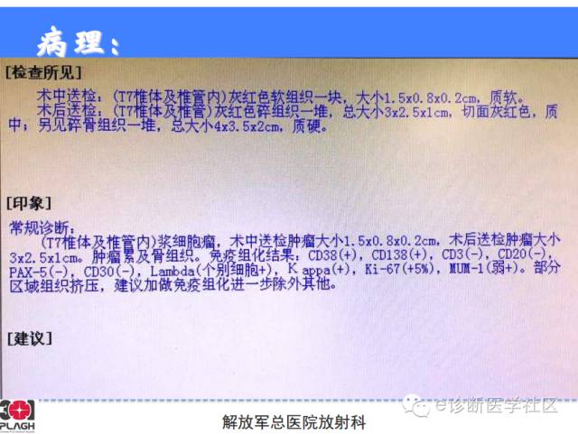 【病例】胸椎浆细胞瘤1例CT及MR影像表现